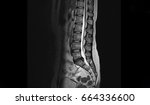 Small photo of Lumbar spinal stenosis MRI scan Sagittal view Lumbosacral spine, L5-S1 is moderate posterior inferior disc protrusion cause bilateral S1 traversing root compression. Chronic low back pain disease