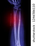 Small photo of Scanned images of the arm (Bone Fracture) and through metal surgery . Surgical steel dam , flim x-ray arm For problems with bone disease.