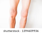 Knees that have problems with the deterioration of the bones of the elderly On a white background