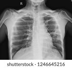 Small photo of Chest x-ray showing A 3 cm pleural based nodule at Lt upper lobe with splicated margin. Thickening of nearby pleural. Nodular infiltration at RUL.