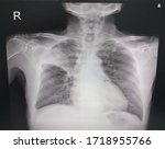 Small photo of Chest x-ray Showing atelectasis with consolidation.Thachea,hearth and mediastinum are normal.minimal right pleural effusion.intact bony thorax.Impression:RUL atelectasis with pneumonia