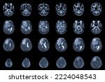 Small photo of MRI Brain Axial views .to evaluate brain tumor. Glioblastoma, brain metastasis isodensity mass with an ill-defined margin and surrounding edema at the right frontal lobe.Medical image concept.
