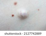 Small photo of Atheroma at the site of her previous removal. The scar of surgical removal of the tumor. A convex benign tumor on the body. Close up.
