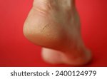 Small photo of Close-up of female gam exposed to camera on lower view angle. Heel of dry leg covered with cracks. Moisturizing cream advertisement concept. Isolated on red background
