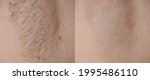 Small photo of Close-up before and after skincare cosmetology armpits epilation treatment concept. Problem underarm chicken skin, Fox Fordyce, black armpit in woman texture background .