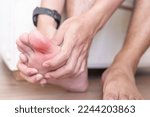 Small photo of man having bunion toes or blister due to wearing narrow shoes and waking or running longtime, barefoot pain due to Plantar fasciitis. Health and medical concept