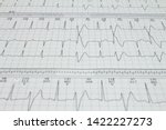 Small photo of Ventricular extrasystole Bigeminism Cardiac arrhythmia recorded on an electrocardiogram. Cardiac Holter study 24 hours.