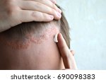 Small photo of Anoint with cream, ointment, medicine forehead, hair line, scalp with psoriasis, dermatitis, problem skin, eczema, dermatology