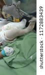 Small photo of Banting, Selangor, Malaysia - 4 July 2018. The Ponseti method is a manipulative technique that corrects congenital clubfoot without invasive surgery. Congenital Talipes Equino Varus (CTEV).
