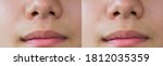 Small photo of Horizontal image compare keloids scars treatment skin facial before and after laser treatments