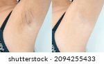 Small photo of Image before and after skincare cosmetology armpits epilation treatment concept. Close up underarm skin Problem rough chicken skin, Fox Fordyce, black armpit in Asian woman.