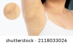 Small photo of Close up armpit woman Image before and after skincare cosmetology armpits epilation treatment concept. Problem underarm chicken skin, Fox Fordyce, black armpit in woman.