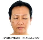 Small photo of Retouched image before and after spot melasma pigmentation facial treatment on middle age asian woman face. Skincare and health problem concept.