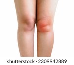 Small photo of Knee effusion, fluid or water round the knee joint. Adult woman with knee swollen the swelling and redness of the skin because of fluid build up inside.