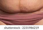 Small photo of The seam on the abdomen of a woman after a caesarean section. Recovery of the female body after the birth of a child, complications.