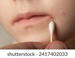 Small photo of Treatment with ointment for a dermatological disease in the corners of the mouth and lips of a little girl. Treatment of seizures, herpes and angular stomatitis, slit-like impetigo, angulitis