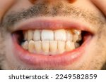 anterior crossbite smile. Curved male teeth, before installing braces.