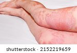 Small photo of Large red,inflamed,scaly rash on man's legs.Acute psoriasis, severe reddening of the skin,an autoimmune,incurable dermatological skin disease.Joints affected by psoriatic arthritis.