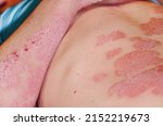 Small photo of Large red inflamed scaly rash on the body of a man. Acute psoriasis in a man, severe redness on the skin, an autoimmune incurable dermatological skin disease. Red redness, spots on the skin.