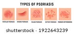 psoriasis rash vector skin hand ... | Shutterstock .eps vector #1922643239