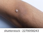 Small photo of Visible Wart on Arm, Verruca on Arm in Close-up
