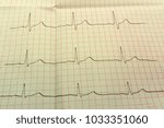 Small photo of Extrasystole On 12 Lead Electrocardiogram Record Paper