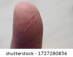 Small photo of Razor Cut on the left digit pollex showing a cut on the epidermis of a Caucasian male