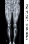 Small photo of Scanogram is a Full-length standing AP radiograph of both lower extremities including the hip, knee, and ankle.