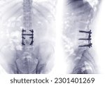 Small photo of X-ray image of lumbar Spine or L-s spine AP and lateral view Post operative Fix Lumbar Plates and screw.