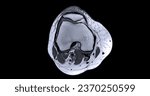 Small photo of Magnetic resonance imaging or MRI of knee joint c for detect tear or sprain of the anterior cruciate ligament (ACL)
