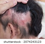 Small photo of Hair loss type Alopecia Areata caused by immune disorders causing the body to get rid of its own hair roots.
