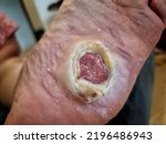 A diabetic foot ulcer presents significant morbidity to patients.