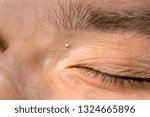 Small photo of Whitehead (closed comedo) - a non-inflamed pore blocked with sebum