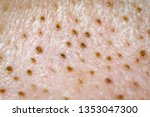 Small photo of Blackhead on the skin - open comedo macro shot