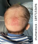 Small photo of Cradle cap is a harmless skin condition that's common in babies.