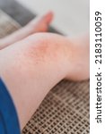Small photo of food allergies, eczema, or diathesis in a small child on the legs.