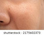 Small photo of Asian male nose and cheek close up has skin problem, large pores, whitehead and blackhead pimple. Pores on the face of a man.
