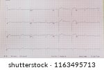 Small photo of Complete heart block.Third degree AV block. Infranodal block.