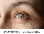 Closeup view of mature woman with cataract