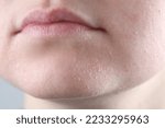 Woman with dry skin on face against light grey background, closeup