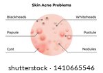 skin acne types diagram. vector ... | Shutterstock .eps vector #1410665546