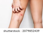 Small photo of Cropped shot of a young woman scratching an insect bite on her thigh. A red rash caused by allergy, inflammatory process. Eczema, atopic dermatitis, lichen, allergy, itching, urticaria, psoriasis