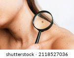 Small photo of Close-up of a big mole on a young woman's neck magnified with a magnifying glass isolated on a gray background. The effect of sunlight on the skin