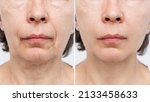 Small photo of Lower part of face and neck of elderly woman with signs of skin aging before after facelift, plastic surgery on white background. Age-related changes, flabby sagging skin, wrinkles, creases, puffiness