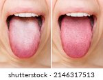 Female tongue with a white...