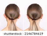 Small photo of Rear view of a woman's head with ears before and after otoplasty isolated on a white background. Result of cosmetic plastic surgery to correct the auricles and get rid of lop - eared. Beauty concept