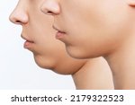 Small photo of Liposuction of double chin. Cropped shot of woman's face with chin before and after cosmetic plastic surgery isolated on a white background. The result of lifting. Fat removal, weight loss. Profile