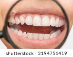 Small photo of Cropped shot of a young woman with white spot on the tooth enamel enlarged in magnifying glass. Oral hygiene, dental care. Dentistry, demineralization of teeth, enamel hypoplasia, pathology, fluorosis