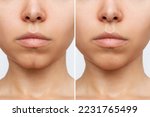 Small photo of Filling the dimple on the chin with fillers. Woman's face with jaws and chin before and after dimplectomy on a white background. The result of cosmetic plastic surgery. Beauty concept. Comparison