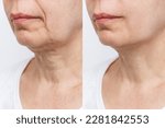 Small photo of Lower part of the face and neck of elderly woman with signs of skin aging before and after facelift, plastic surgery on white background. Rejuvenation of flabby sagging skin, wrinkles, creases